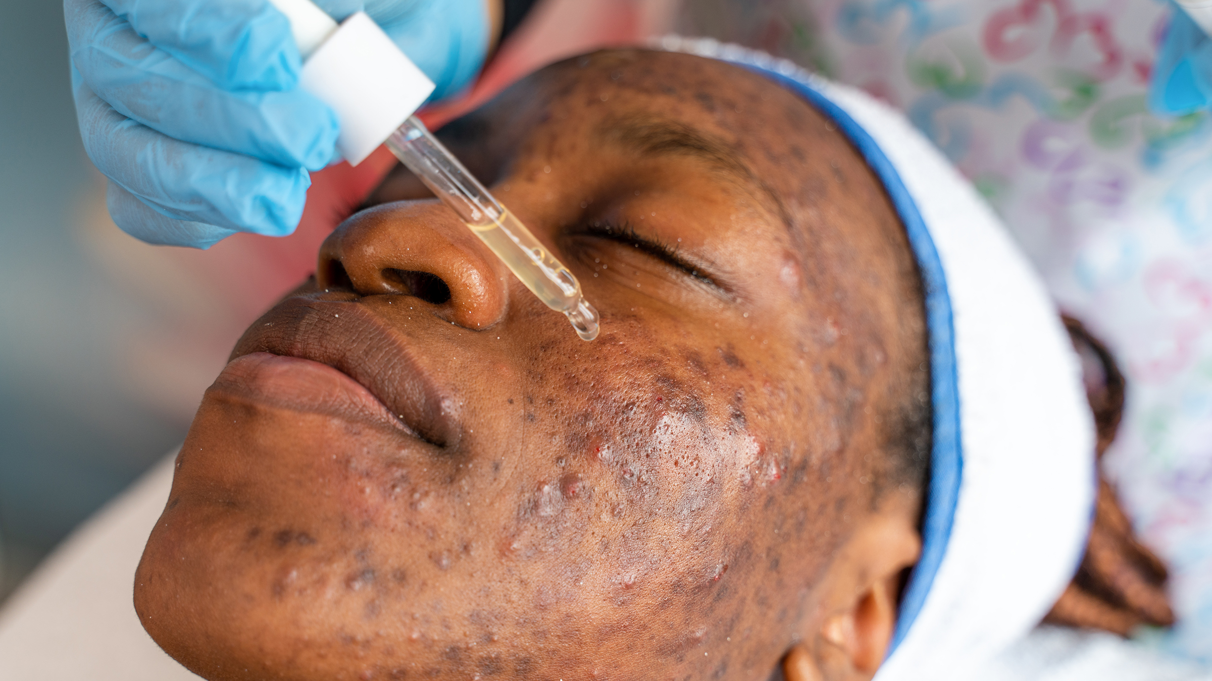 Acne Facial
